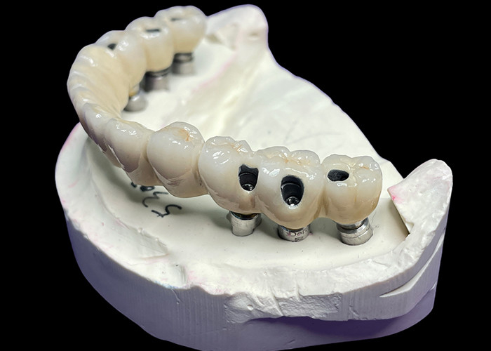 Vương miện và cầu cấy ghép răng vòm đầy đủ phục hồi chức năng và thẩm mỹ với các giải pháp tiên tiến