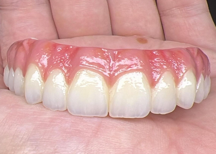 Sức khỏe răng miệng Cấy ghép răng giả được hỗ trợ Đường cầu bề mặt đánh bóng hỗ trợ răng giả đầy đủ