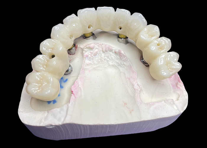 Vương miện và cầu cấy ghép răng vòm đầy đủ phục hồi chức năng và thẩm mỹ với các giải pháp tiên tiến