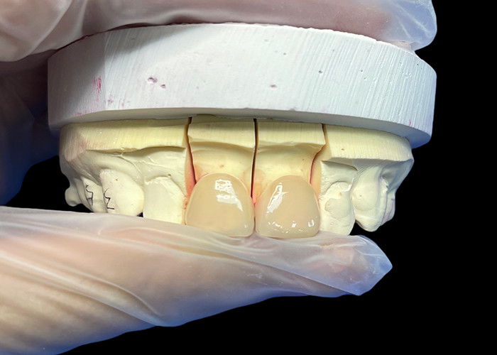 Độ bền chính xác EMAX Porcelain Veneer cắt ngang cho phục hồi thẩm mỹ trông tự nhiên