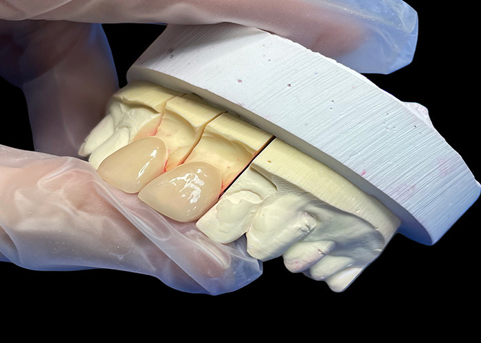 Độ bền chính xác EMAX Porcelain Veneer cắt ngang cho phục hồi thẩm mỹ trông tự nhiên