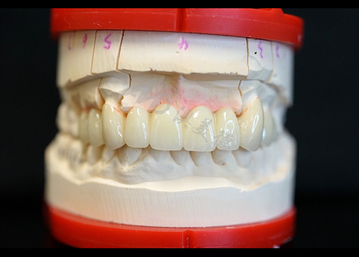 Sức mạnh Vẻ đẹp tự nhiên Vương miện Zirconia rắn Hoàn hảo cho răng đơn hoặc đa răng