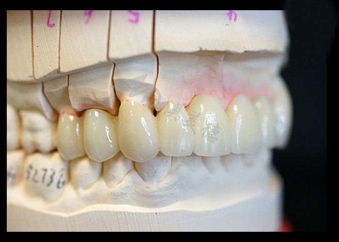 Sức mạnh Vẻ đẹp tự nhiên Vương miện Zirconia rắn Hoàn hảo cho răng đơn hoặc đa răng