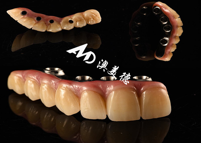 Nhìn tự nhiên cấy ghép răng cây cầu vương miện được cố định với Titanium trụ cột cho phẫu thuật mất răng