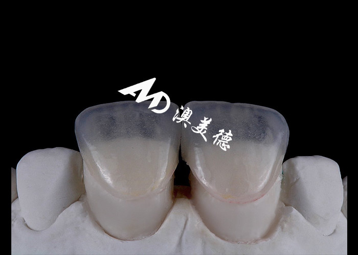 Thay đổi nụ cười của bạn với IPS emax Press Porcelain Veneers sức mạnh thẩm mỹ và độ bền kết hợp