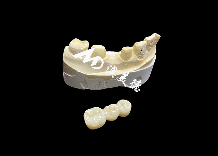 Vương miện nha khoa Zirconia thẩm mỹ cứng cao với độ mờ và chống vỡ từ phòng thí nghiệm nha khoa Trung Quốc