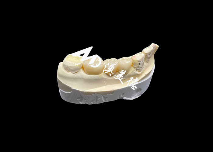 Vương miện nha khoa Zirconia thẩm mỹ cứng cao với độ mờ và chống vỡ từ phòng thí nghiệm nha khoa Trung Quốc