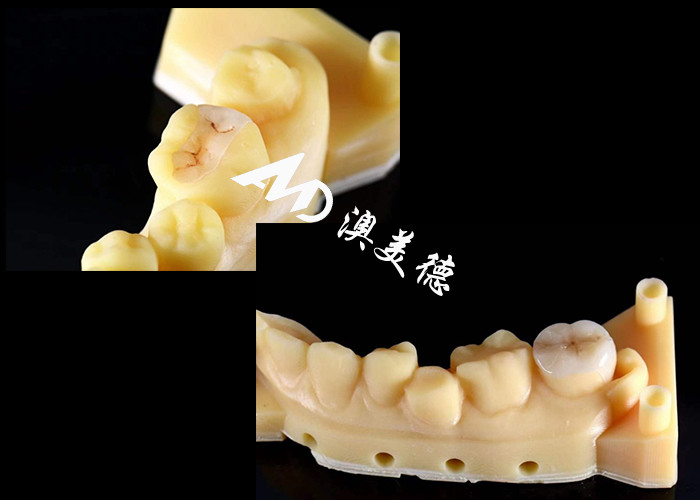 Đồ cẩm thô chính xác và Onlays cho sửa chữa răng với màu sắc tự nhiên vật liệu hypoallergenic và phù hợp liền mạch cho sự thoải mái và độ bền vượt trội