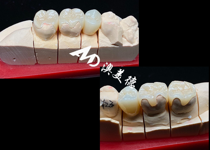 OEM Precision Fit Ceramic Inlays Onlays cho phục hồi răng bền và trông tự nhiên với sức mạnh và độ tin cậy vượt trội
