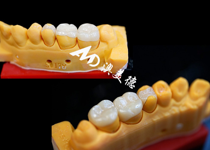 OEM Precision Fit Ceramic Inlays Onlays cho phục hồi răng bền và trông tự nhiên với sức mạnh và độ tin cậy vượt trội