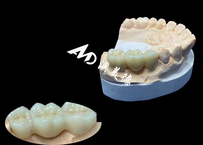 Màu sắc tự nhiên Zirconia vương miện răng chống nứt cho một nụ cười hoàn hảo từ Trung Quốc phòng thí nghiệm nha khoa