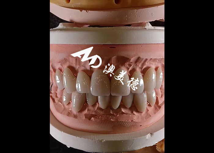 Hình dáng nha khoa EMAX Veneers nha khoa 0.3-0.5mm dày cho phục hồi thẩm mỹ