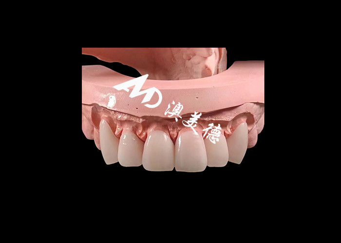 Hình dáng nha khoa EMAX Veneers nha khoa 0.3-0.5mm dày cho phục hồi thẩm mỹ
