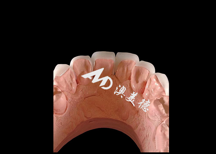 Hình dáng nha khoa EMAX Veneers nha khoa 0.3-0.5mm dày cho phục hồi thẩm mỹ