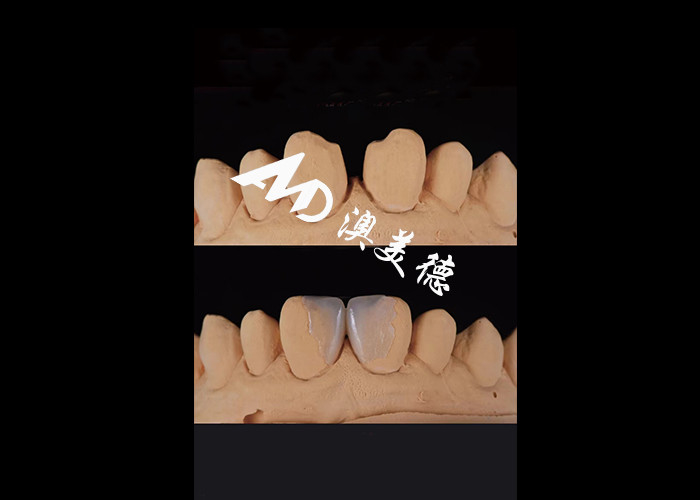 0.3-0.5mm Ultra mỏng IPS EMAX Porcelain Veneers cho thẩm mỹ Smile Makeovers