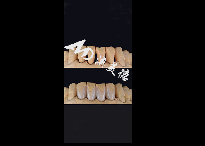 0.3-0.5mm Ultra mỏng IPS EMAX Porcelain Veneers cho thẩm mỹ Smile Makeovers