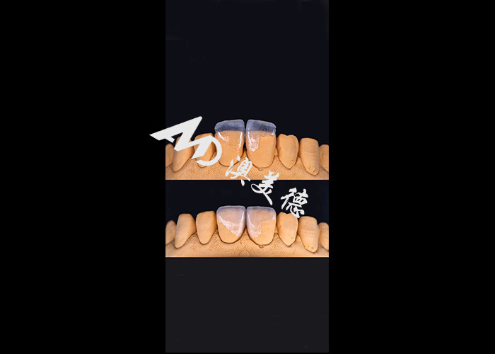 0.3-0.5mm Ultra mỏng IPS EMAX Porcelain Veneers cho thẩm mỹ Smile Makeovers