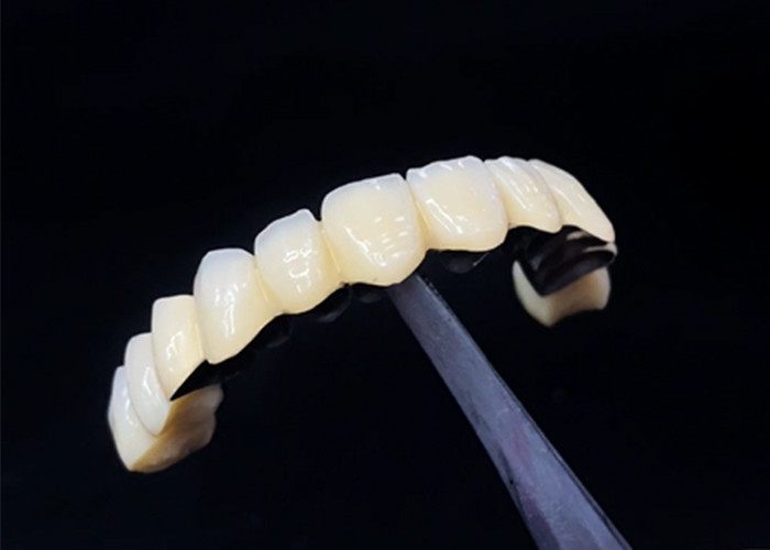 Đồ xốp được hợp nhất với vương miện kim loại kết hợp độ bền và vẻ đẹp cho sức khỏe răng miệng