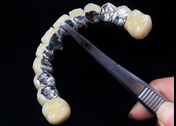 Đồ xốp được hợp nhất với vương miện kim loại kết hợp độ bền và vẻ đẹp cho sức khỏe răng miệng