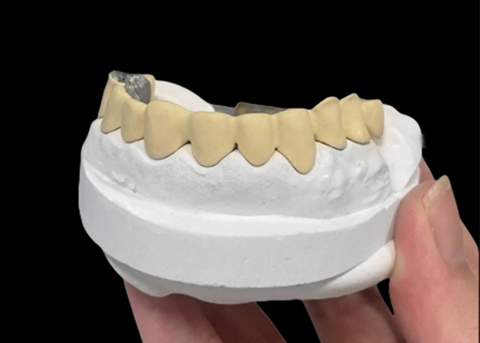 Đồ xốp được hợp nhất với vương miện kim loại kết hợp độ bền và vẻ đẹp cho sức khỏe răng miệng