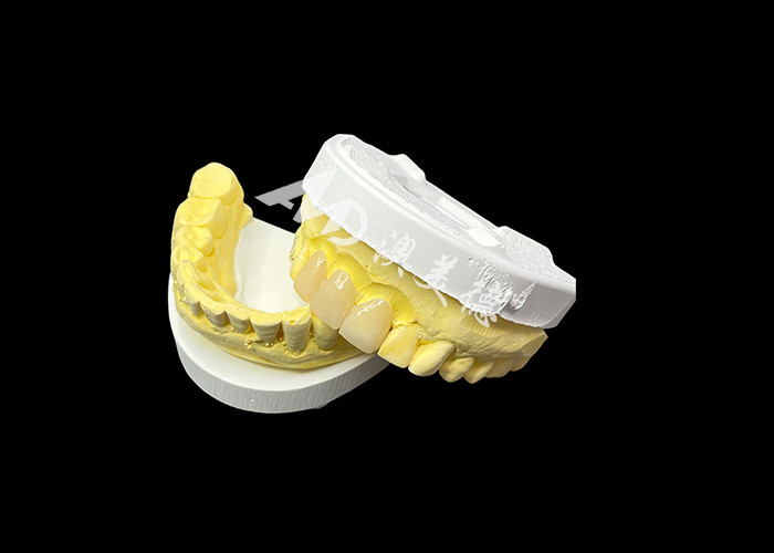 Cải thiện thẩm mỹ nha khoa của bạn với một cây cầu vương miện gốm kết hợp thẩm mỹ đặc biệt và khả năng tương thích sinh học xuất sắc cho một nụ cười tự nhiên, thoải mái