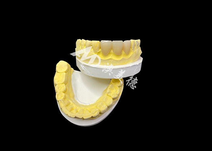 Cải thiện thẩm mỹ nha khoa của bạn với một cây cầu vương miện gốm kết hợp thẩm mỹ đặc biệt và khả năng tương thích sinh học xuất sắc cho một nụ cười tự nhiên, thoải mái