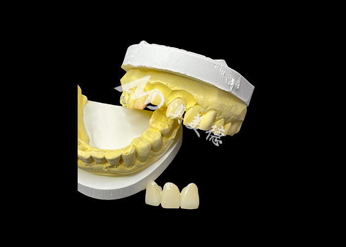 Cải thiện thẩm mỹ nha khoa của bạn với một cây cầu vương miện gốm kết hợp thẩm mỹ đặc biệt và khả năng tương thích sinh học xuất sắc cho một nụ cười tự nhiên, thoải mái