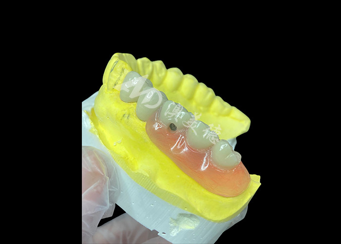 Sự kết hợp cá nhân PFM + răng giả tháo rời Giải pháp cuối cùng cho sự thoải mái và thẩm mỹ