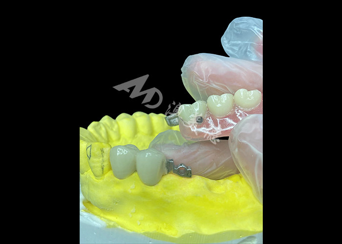 Sự kết hợp cá nhân PFM + răng giả tháo rời Giải pháp cuối cùng cho sự thoải mái và thẩm mỹ