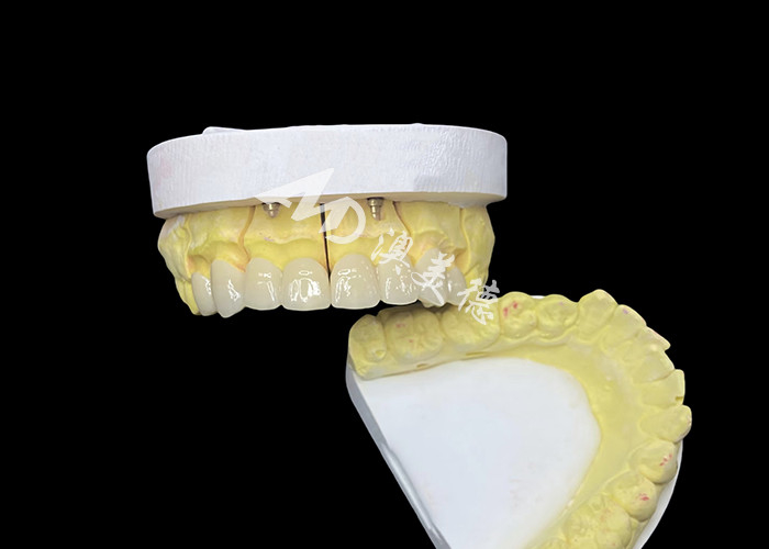 Đạt được một nụ cười hoàn hảo với vương miện răng gốm chất lượng cao cho ngoại hình tự nhiên và sức mạnh lâu dài