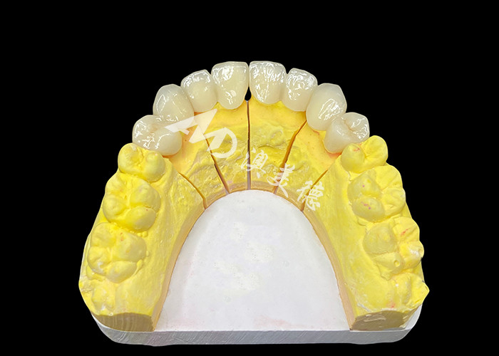 Đạt được một nụ cười hoàn hảo với vương miện răng gốm chất lượng cao cho ngoại hình tự nhiên và sức mạnh lâu dài