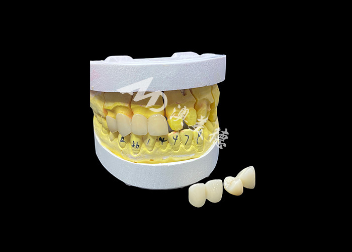 Đạt được một nụ cười hoàn hảo với vương miện răng gốm chất lượng cao cho ngoại hình tự nhiên và sức mạnh lâu dài