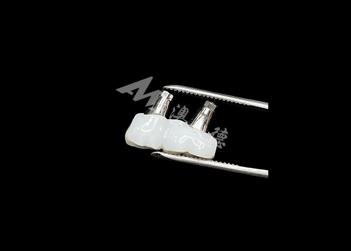 Vương miện cấy ghép nha khoa bằng Zirconia với vỏ vỏ titanium để tăng sự thoải mái và thẩm mỹ
