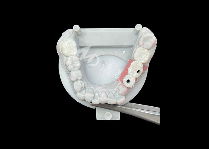 Vương miện cấy ghép nha khoa bằng Zirconia với vỏ vỏ titanium để tăng sự thoải mái và thẩm mỹ
