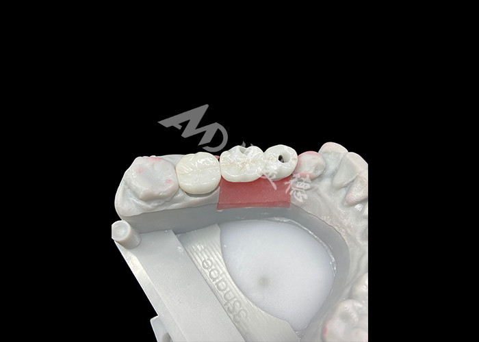 Vương miện cấy ghép nha khoa bằng Zirconia với vỏ vỏ titanium để tăng sự thoải mái và thẩm mỹ