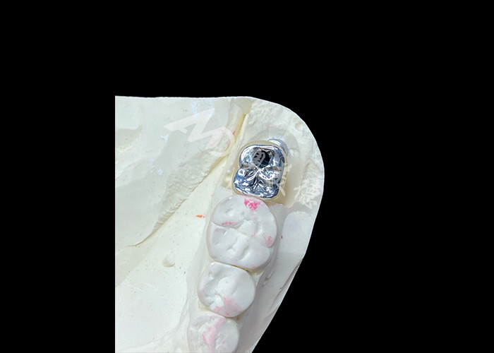 Vương miện cấy ghép răng với vỏ titanium và vương miện PFM gốm mỏng với kim loại