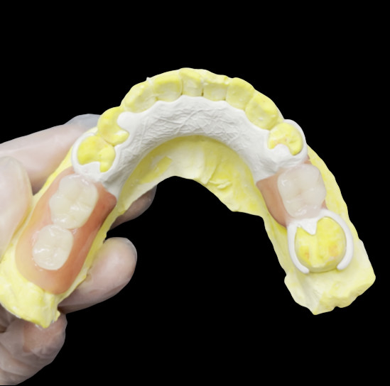 Aesthetic Custom Made Removable Partial Denture HPP Khung cho thay răng một phần tự nhiên