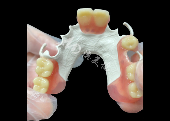 Aesthetic Custom Made Removable Partial Denture HPP Khung cho thay răng một phần tự nhiên