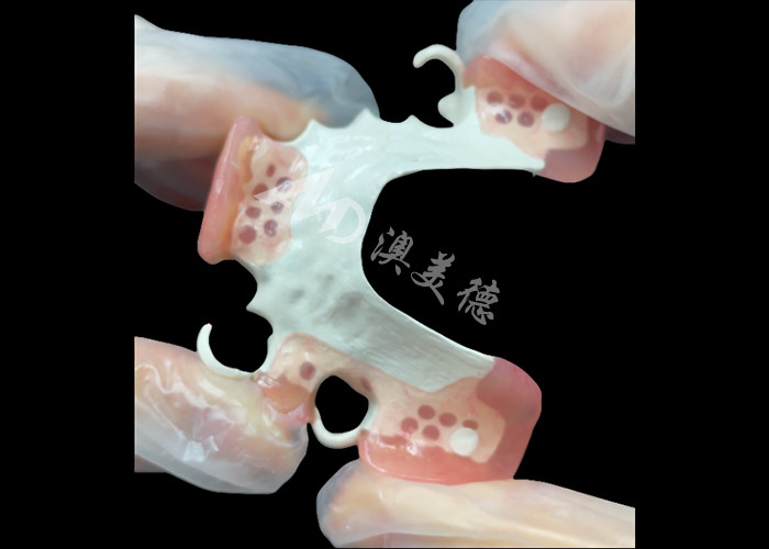 Aesthetic Custom Made Removable Partial Denture HPP Khung cho thay răng một phần tự nhiên