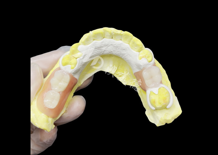 Mẫu răng giả một phần đúc tùy chỉnh với khung HPP để tăng cường nhai và nói