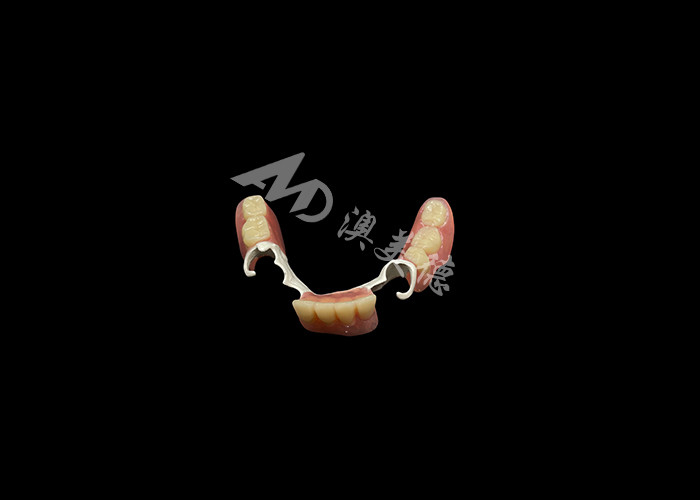 Mẫu răng giả đúc phần bền với khung HPP để khôi phục nụ cười của bạn