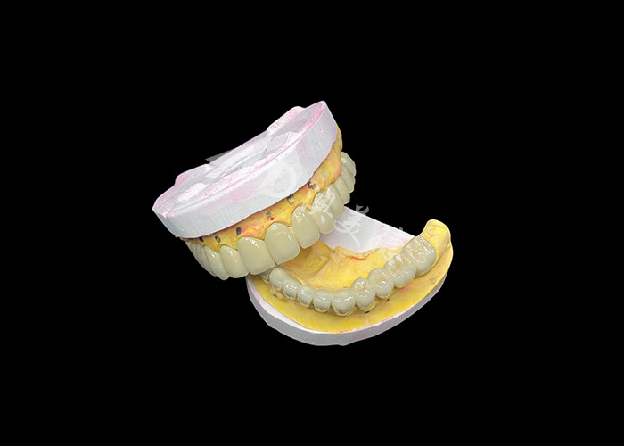 Đồ xốp tùy chỉnh được hợp nhất với cây cầu vương miện răng kim loại để tăng cường nụ cười tự nhiên