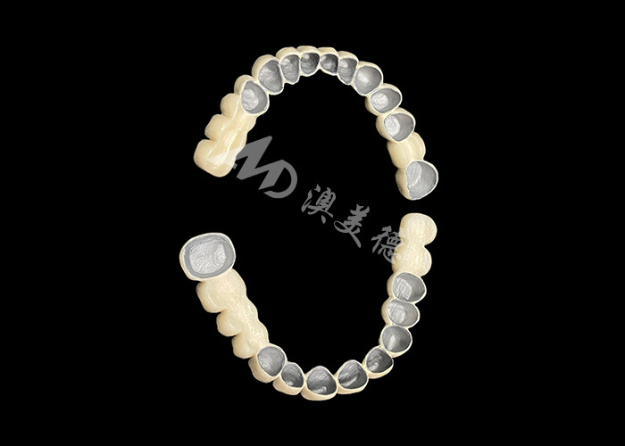 Đồ xốp tùy chỉnh được hợp nhất với cây cầu vương miện răng kim loại để tăng cường nụ cười tự nhiên