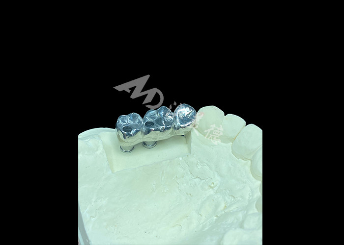 Chất cấy ghép răng dài lâu Full Cast Titanium Crown Dental Implant Molar Để thay răng bị thiếu