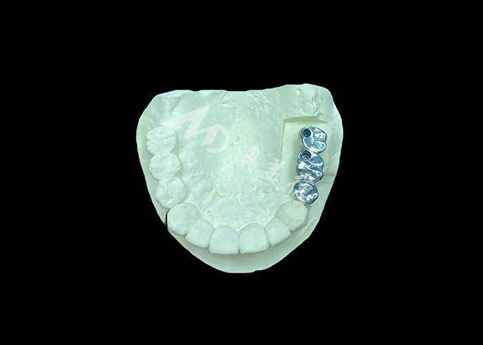 Chất cấy ghép răng dài lâu Full Cast Titanium Crown Dental Implant Molar Để thay răng bị thiếu