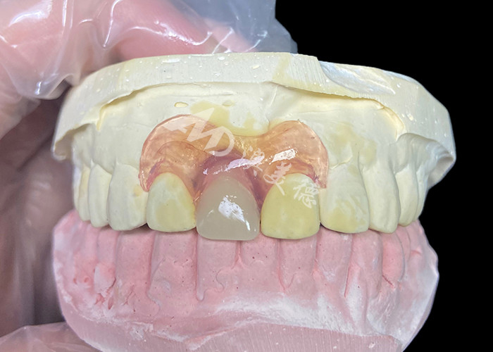 Nesbit răng giả linh hoạt cho răng cắt cung cấp một giải pháp thay răng có thể tháo rời liền mạch