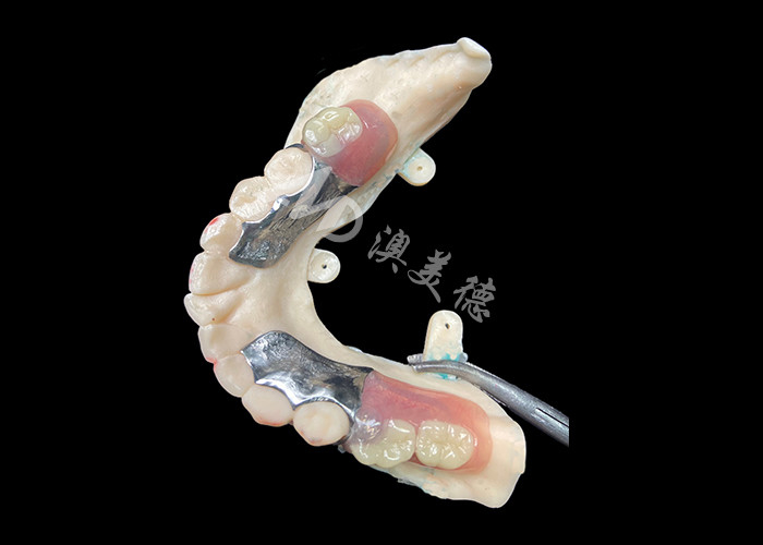 Tùy chỉnh đúc phần răng giả khung kim loại chính xác cho phù hợp tối ưu và chức năng