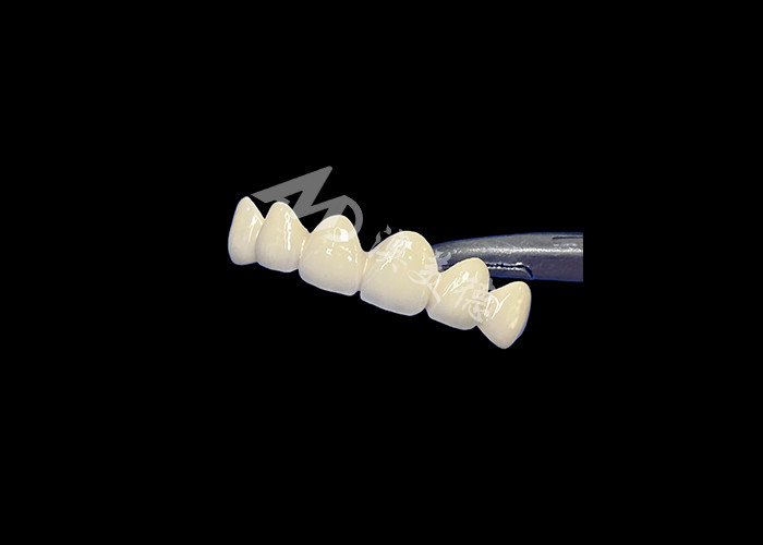 Đồ xốp tương thích sinh học được hợp nhất với vương miện kim loại Độ bền cao để phục hồi tốt hơn