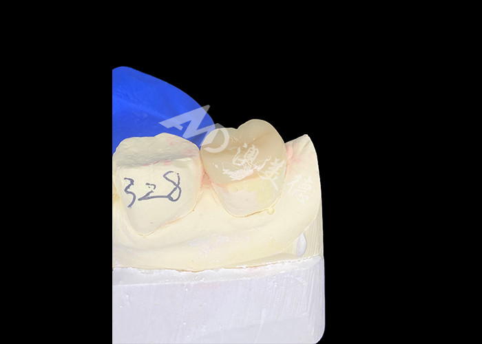 IPS E.max Ceramic Inlays Onlays Trộn liền mạch Nhìn tự nhiên Và bền với răng của bạn