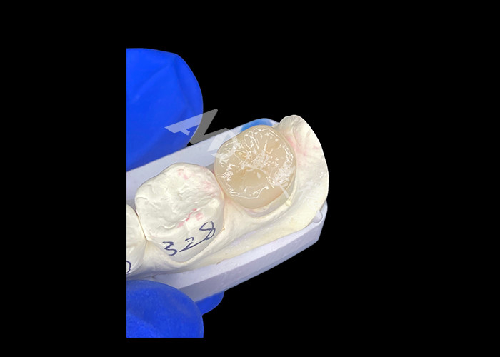 IPS E.max Ceramic Inlays Onlays Trộn liền mạch Nhìn tự nhiên Và bền với răng của bạn